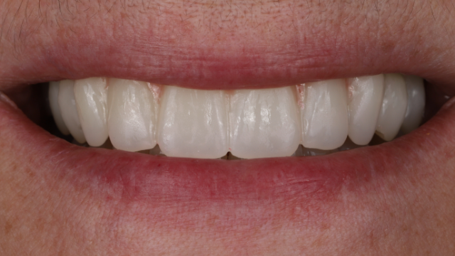Full Mouth Reconstruction — after treatment by Dr. Jay Siddiqui at Radiant Dental Care Chevy Chase