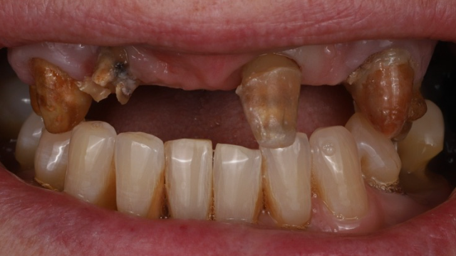 Full Mouth Reconstruction — before treatment by Dr. Jay Siddiqui at Radiant Dental Care Chevy Chase