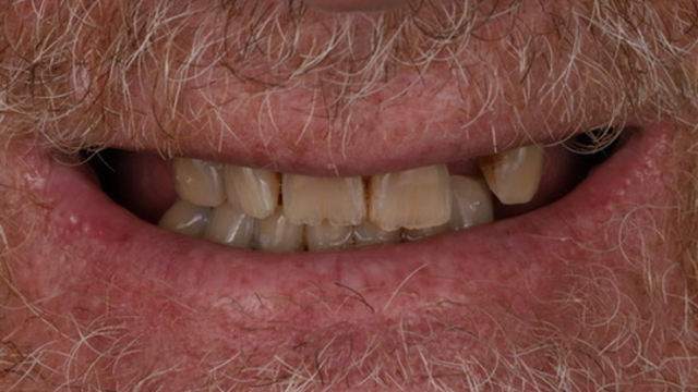 Full Arch Restoration — before treatment by Dr. Jay Siddiqui at Radiant Dental Care Chevy Chase