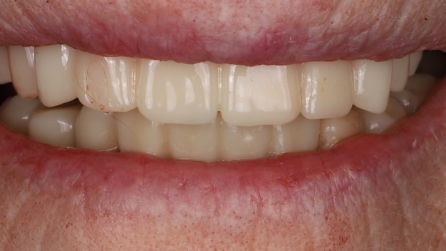 Upper Veneers & Crowns — after treatment by Dr. Jay Siddiqui at Radiant Dental Care Chevy Chase
