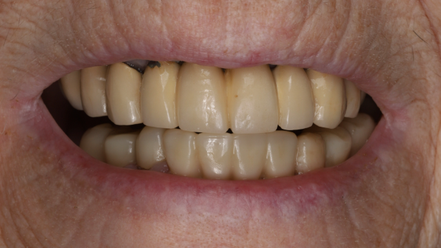 Upper Veneers & Crowns — before treatment by Dr. Jay Siddiqui at Radiant Dental Care Chevy Chase