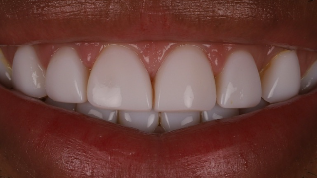 Porcelain Veneers — before treatment by Dr. Jay Siddiqui at Radiant Dental Care Chevy Chase