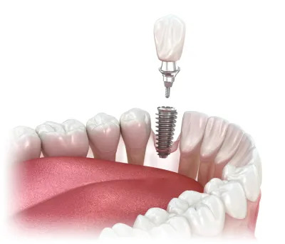 type of implants