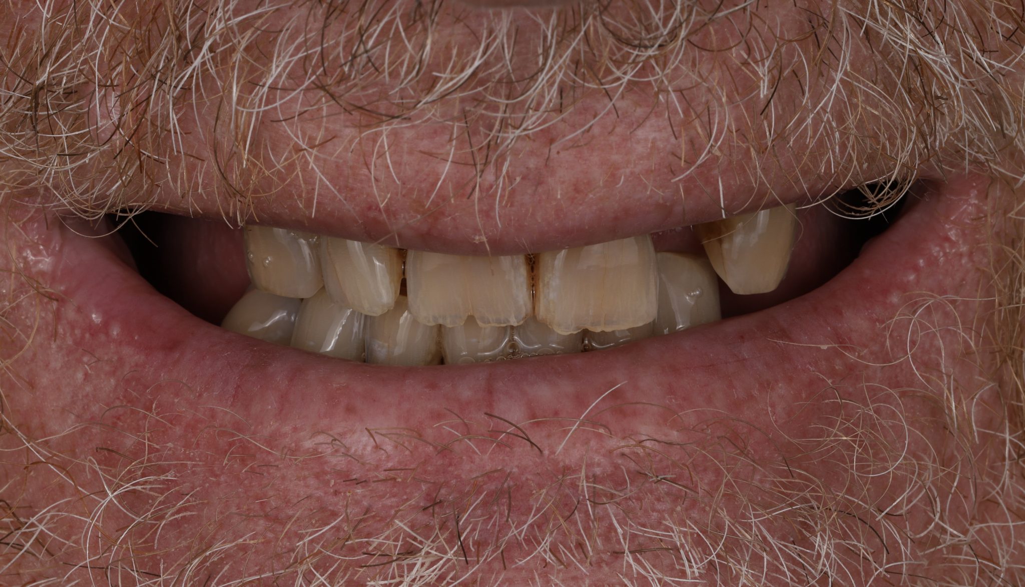 Full-arch implant case — before: worn and failing upper dentition