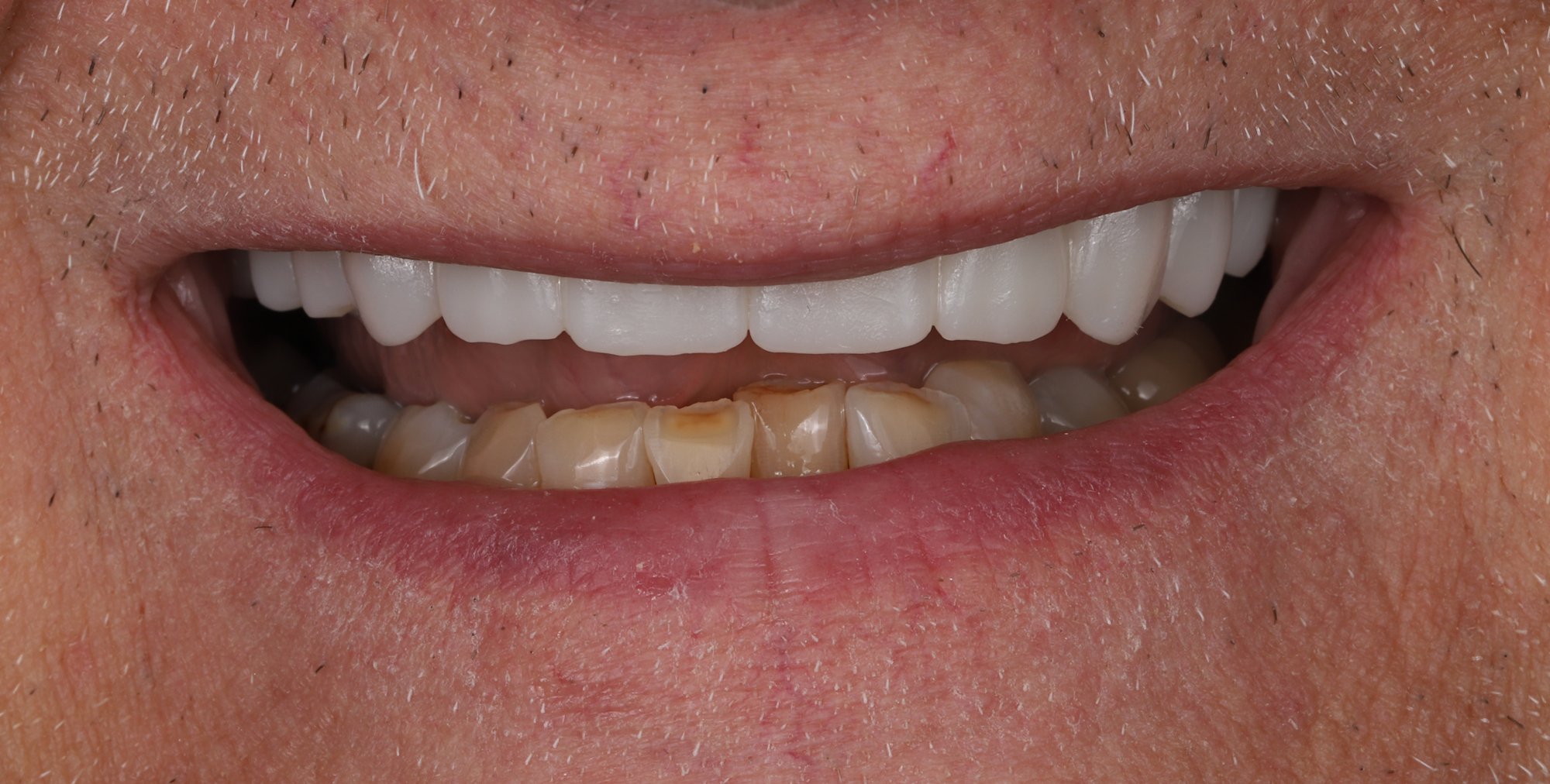 Smile makeover case — after: complete upper arch restoration