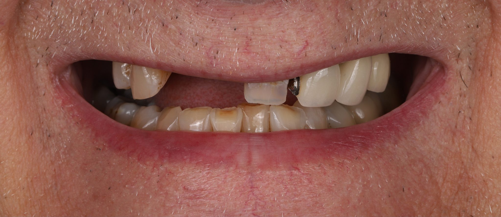 Smile makeover case — before: broken upper front teeth with missing lateral incisor