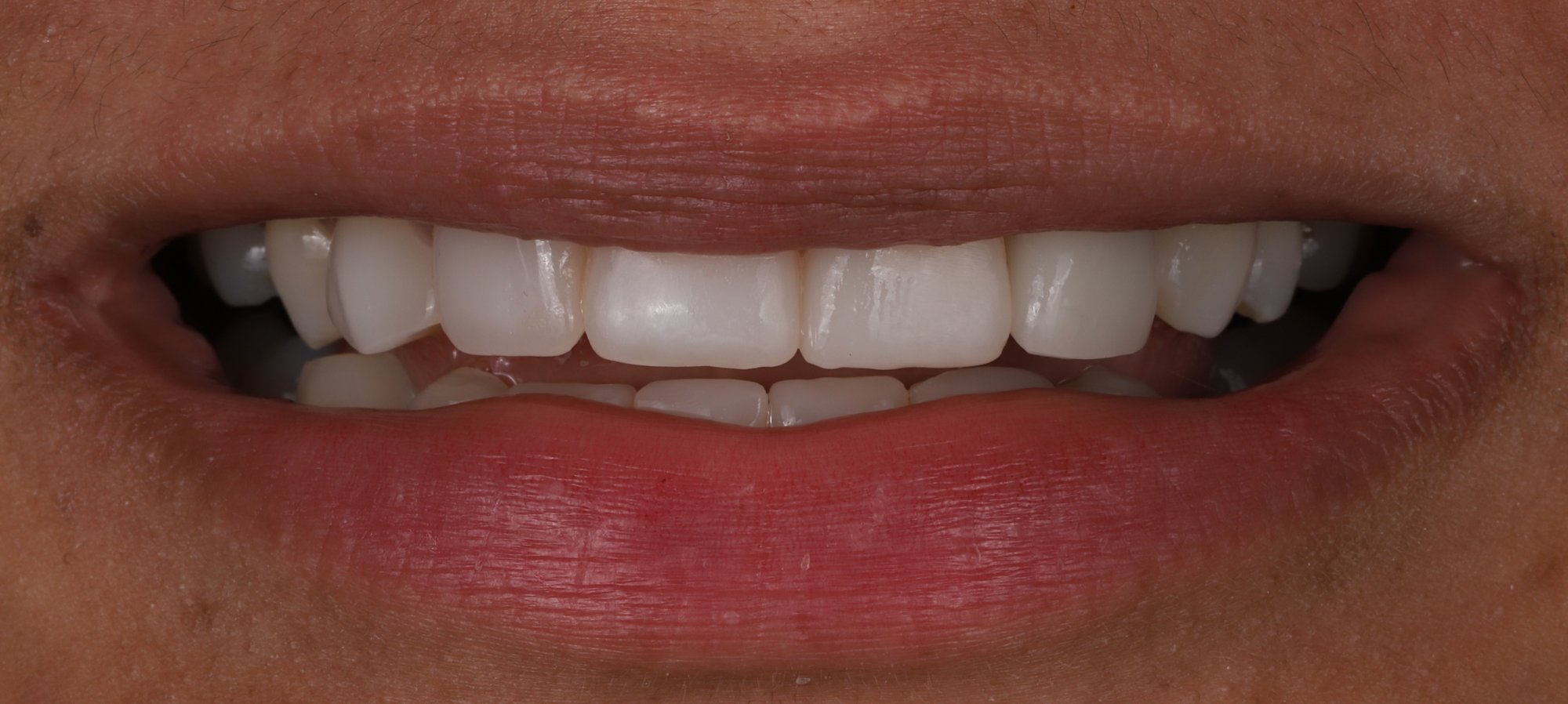 No-prep veneer case — after: bonded porcelain veneers restoring proportion and brightness