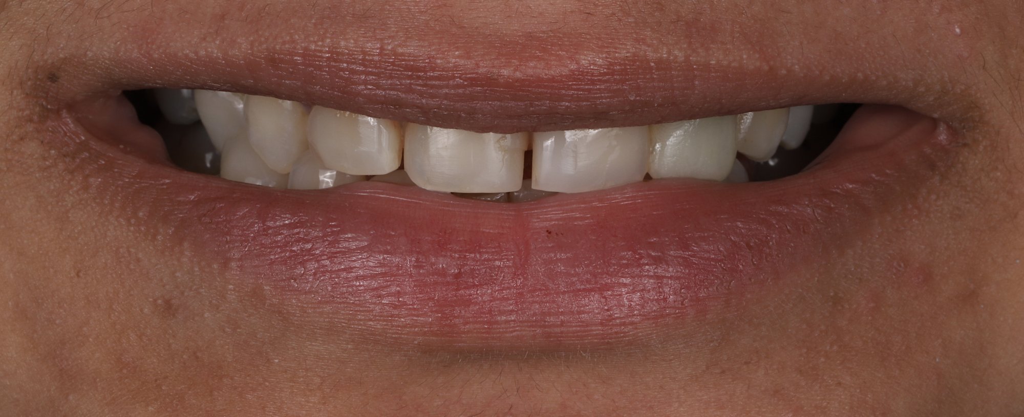 No-prep veneer case — before: worn upper front teeth with uneven edges