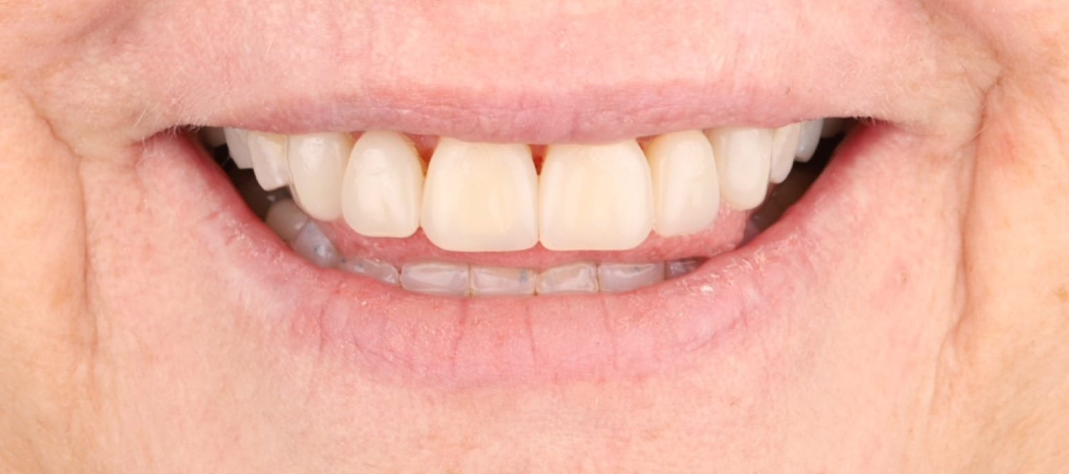 Porcelain veneers case — after: natural-looking layered porcelain veneers restoring symmetry and color