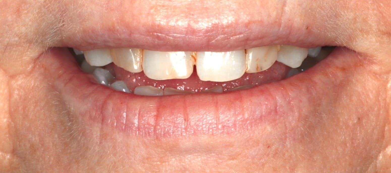 Porcelain veneers case — before: worn, discolored upper front teeth with spacing
